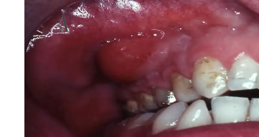علائم آبسه