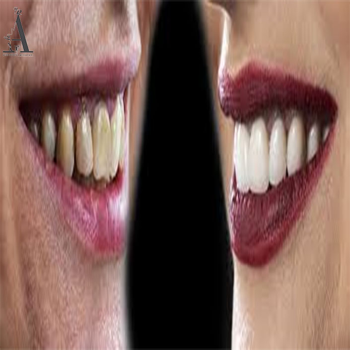 مراقبت از کامپوزیت